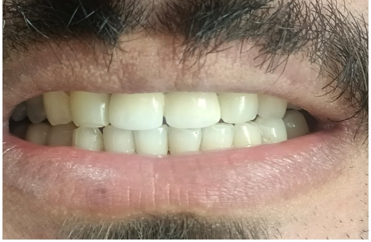 After treatment