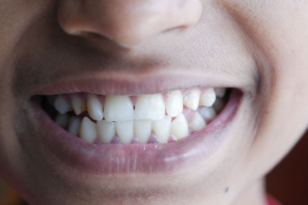 Diastema Closure